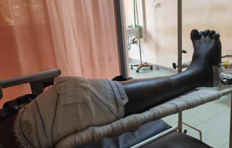 La jambe de Zakarias immobilisée